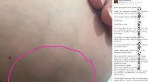 So Sieht Brustkrebs Aus Sie Will Andere Frauen Warnen