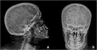 Expert selections from ash 2020: Radiological Imaging In Multiple Myeloma Review Of The State Of The Art Springerlink