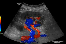 Renal Artery Doppler Ultrasonido Medical Anatomia