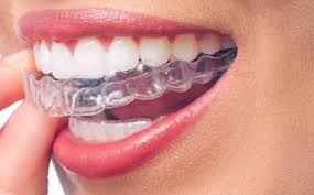 Braces have successfully corrected crooked teeth over the years. Invisible Braces For Teeth Straightening Teeth Braces
