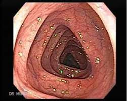 If you take aspirin or nsaids such as advil, motrin, celebrex or. Preparing For Colonoscopy Intechopen
