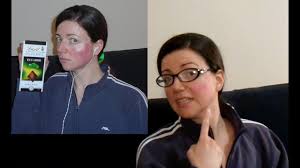 Rosacea — global diversity and optimized outcome: Light Therapy For Rosacea Treatment Explained Lto Rosacea