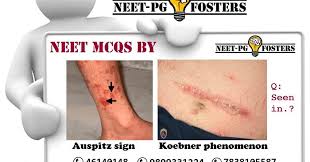 Image result for Auspitz Sign