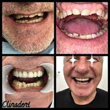 Nous (visiter) des sites extraordinaires pendant ce séjour en grèce. Cas Du Jour Chez Clinadent Paris 15 75015 Dentiste Centre Dentaire Paris 15 Grenelle Groupe Clinadent