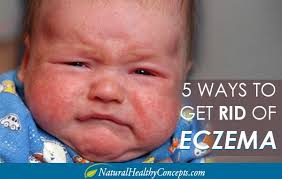 5 Natural Ways To Manage Eczema Healthy Concepts With A Nutrition Bias How To Treat Eczema Baby Eczema Treatment Baby Eczema Remedies