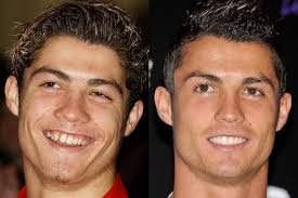Diese 25 Promis Haben Sich Zum Gluck Die Zahne Richten Lassen Celebrityred Plastische Chirurgie Ronaldo Cristiano Ronaldo