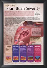 understanding skin burn severity chart 24x36 emergency