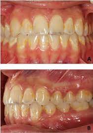 Diagnosis Prevention And Treatment Of White Spot Lesions Related To Orthodontics
