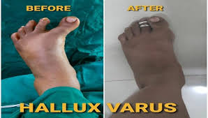 Image result for Hallux Varus