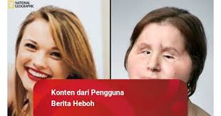 Katie Stubblefield, Manusia Termuda yang Menjalani Transplantasi Wajah