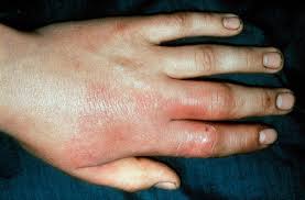 Image result for Erysipeloid