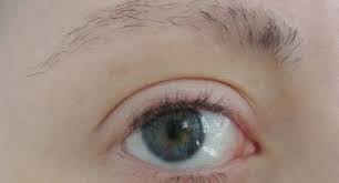 Those conditions most often related to brow loss include hypothyroidism and an imbalance in the body's endocrine system. What Causes Lashes And Brows To Thin Or Fall Out