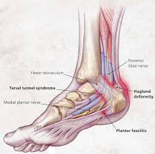Haglund's syndrome is a cause of retrocalcaneal pain. Heel Pain Causes Symptoms Diagnosis Pain Relief Heel Pain Treatment