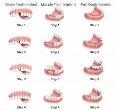 Glistening Dental Implants Steps Dentalimplantsburnaby Dentalimplantsmarketing Dental Implants Cost Dental Implants Implant Dentist