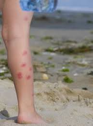 Flea Bites That Look Like Mosquito Bites Pin On To Read Later