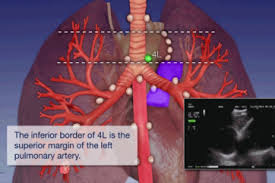 Diagnosis was made on the tbnaslides and cell block/biopsy material. Ebus Tbna Olympus Professional Education On Demand Library