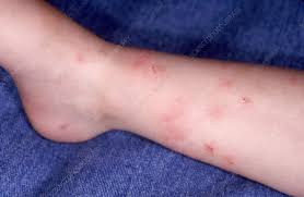 Image result for flea bite