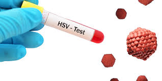 Image result for Herpes Simplex Virus Testing
