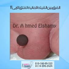 الخصية المعلقة عند الاطفال بالصور