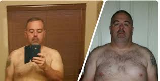 weight loss surgery success stories