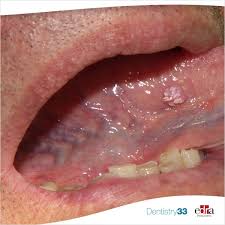 Image result for white cancer on tongue)
