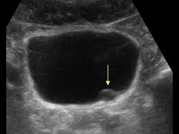 Wk 7 Renal Pathology Small Ureterocele On The Lt Side Medical Ultrasound Ultrasound Sonography Ultrasound