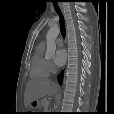 Sternum thoracic cage posterior surface of sternum. Movement Artifact Simulating Sternal Fracture Radiology Case Radiopaedia Org