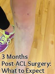 See full list on practicalpainmanagement.com Acl Post Surgery 3 Months Nina Elise Acl Surgery Acl Surgery Recovery Meniscus Surgery Recovery