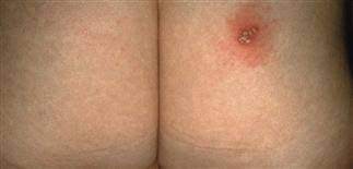 Hsv i and hsv ii. Herpes Simplex Cold Sores Fever Blisters Plastic Surgery Key