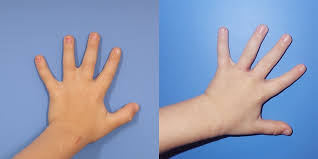 Image result for Syndactyly