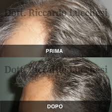 Autotrapianto di capelli a torino milano. Trapianto Capelli
