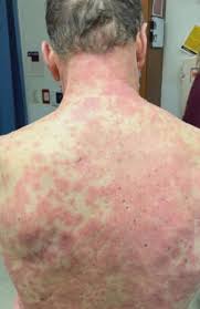 The side effects of the johnson & johnson vaccine appear to be less severe than the pfizer and moderna vaccines. Man S Skin Peeled Off After Johnson Johnson Covid Vaccine