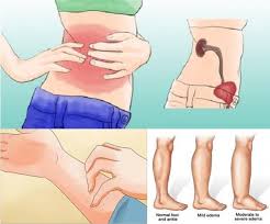 8 Early Warning Signs Your Kidneys Aren T Working As Well As They Should Kidney Disease Kidney Disease Symptoms Kidney Infection
