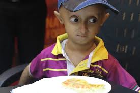 Image result for progeria case in bihar