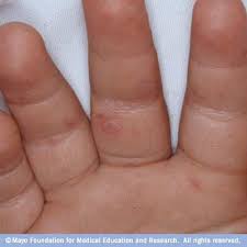 Hand Foot And Mouth Disease On The Hand Hand Foot And Mouth Disease Symptoms Childrens Health
