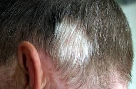 How to turn white grey hair to black hair naturally permanently in 15 days welcome to ruclip channel pana we know that. Poliosis Causes Symptoms And Treatment