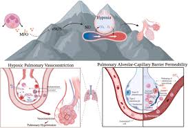 Image result for High Altitude Edema