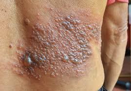 Image result for herpes zoster