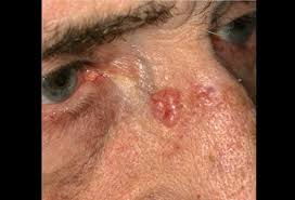 Find facts and statistics for reporting about skin cancer. Basal Cell Carcinoma Ear Picture Image On Medicinenet Com