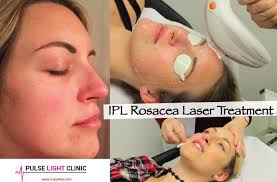 Pulse Light Clinic IPL Laser Rosacea Treatment