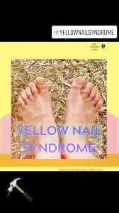 Image result for Yellow nail syndrome feet