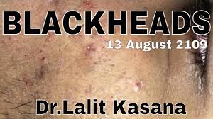 If you've got an entire youtube playlist featuring pimple pops, blackhead extractions, and dr. Blackheads Removal By Dr Lalit Kasana 13 August 2019 Youtube