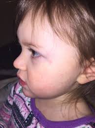 Petechiae are often a symptom of an underlying medical condition or a bacterial infection. Concerned About My Toddlers Face Petechiae Babycenter