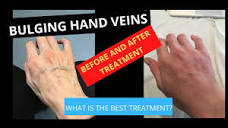 Varicose Veins on the Hands Treatment by Hand Rejuvenation - YouTube