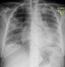 Même si certains symptômes sont assez évocateurs de cette maladie, aucun n'est spécifique et il arrive parfois que le patient ne présente aucun symptôme. Legionella Pneumonia Radiology Reference Article Radiopaedia Org