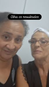Cliente com alupécia já vemos resultado na oitava sessão., Esta ficando bem  cheio., Venha vc fazer sua avaliação., 13 986819663