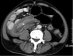 We did not find results for: Adult Intussusception A Retrospective Review Of 41 Cases