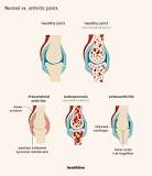 Image result for what helps with arthritis pain natural treatment