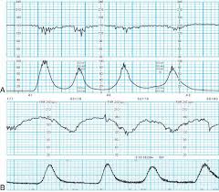Image result for Early Deceleration