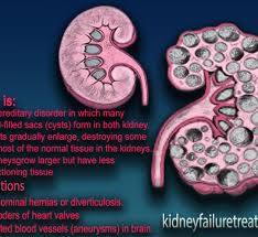 Ayurvedic Medicine For Polycystic Disease Kidney Failure